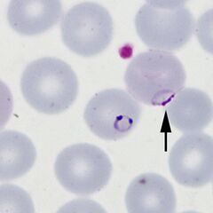 Multiple early trophozoites within a single erythrocyte, one having a double chromatin dot