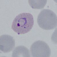 early red cell change and dots