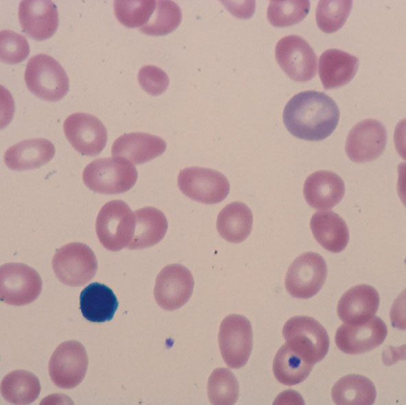 File:Anisocytosis 2.jpg
