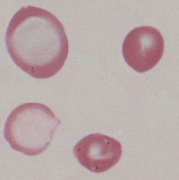 File:RC F anisocytosis G.jpg