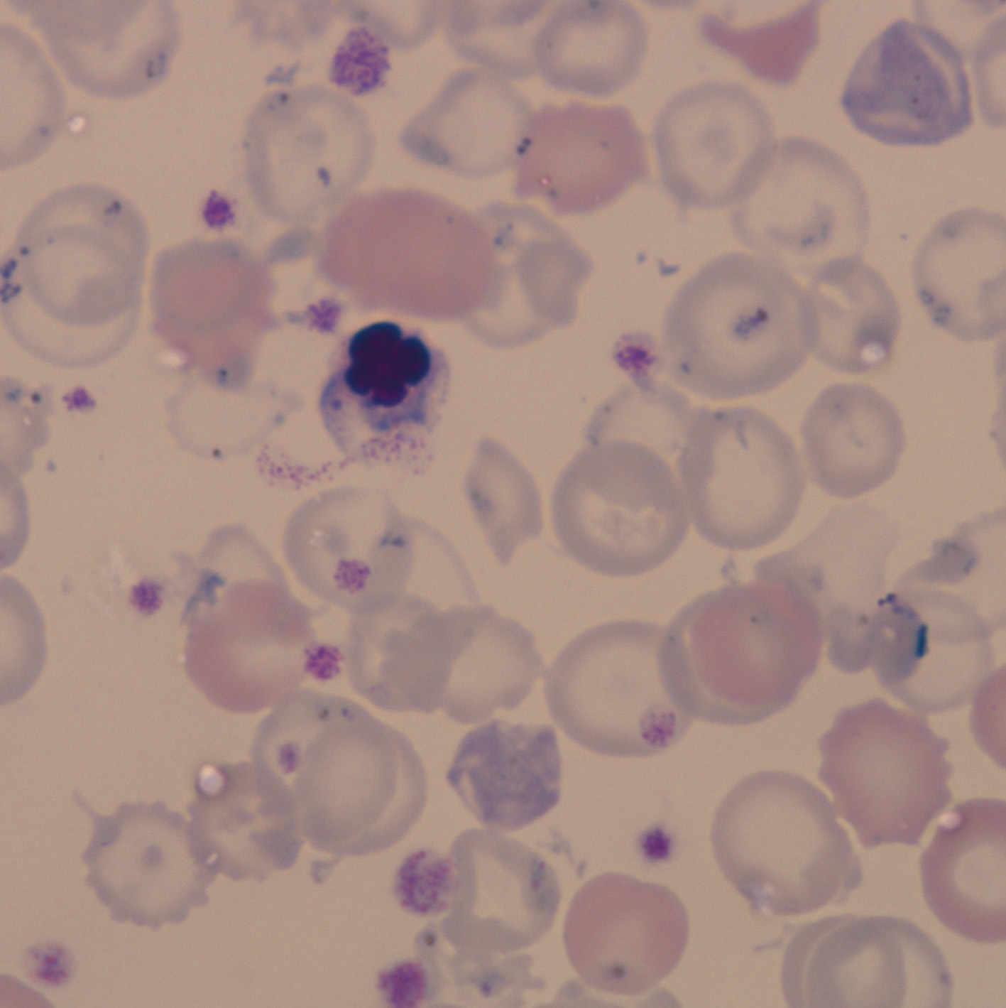 Anisochromia Haematologyetc co uk