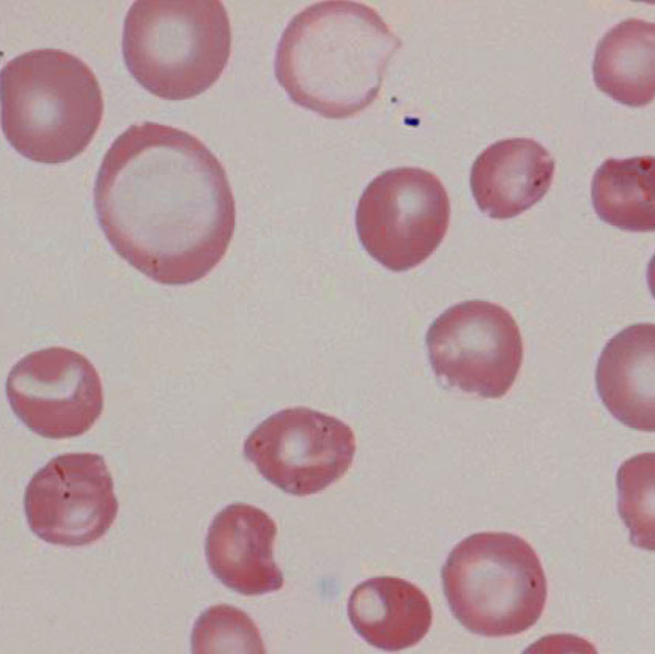 File:Anisocytosis 1.jpg