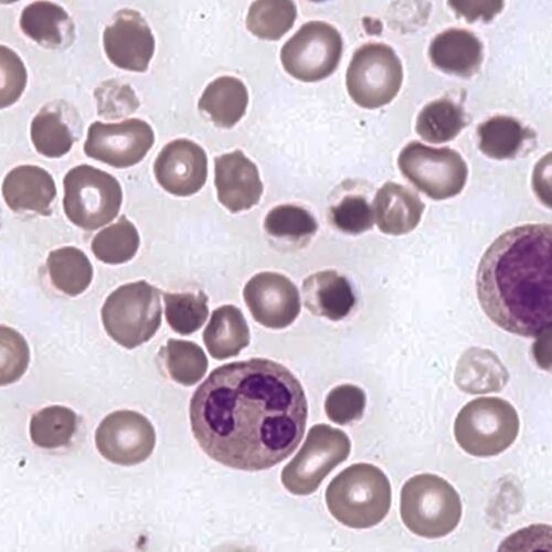 Hemighost cells - haematologyetc.co.uk