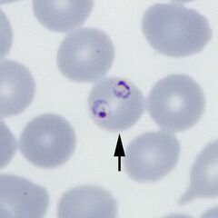 'Multiple parasites Two arrowed parasites within a single red cells