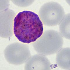 Late trophozoite Note the solid parasite and the red cell begins to show distortion.