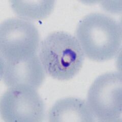 Very early form Very early red cell changes with fine dots visible