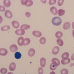 Anisocytosis 2.jpg