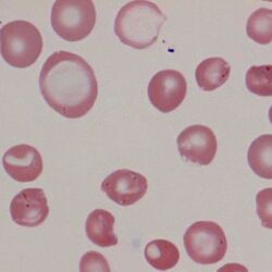 Anisocytosis 1.jpg