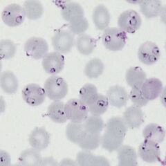 High parasitaemia Most of the typical early trophozoite P.falciparum forms are present